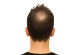 Vorher-Nachher-Rückansicht eines Mannes mit Haarausfall und sichtbarer Haarverdichtung durch Stop&Grow® for Men